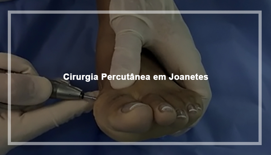 Cirurgia Percutânea em Joanetes