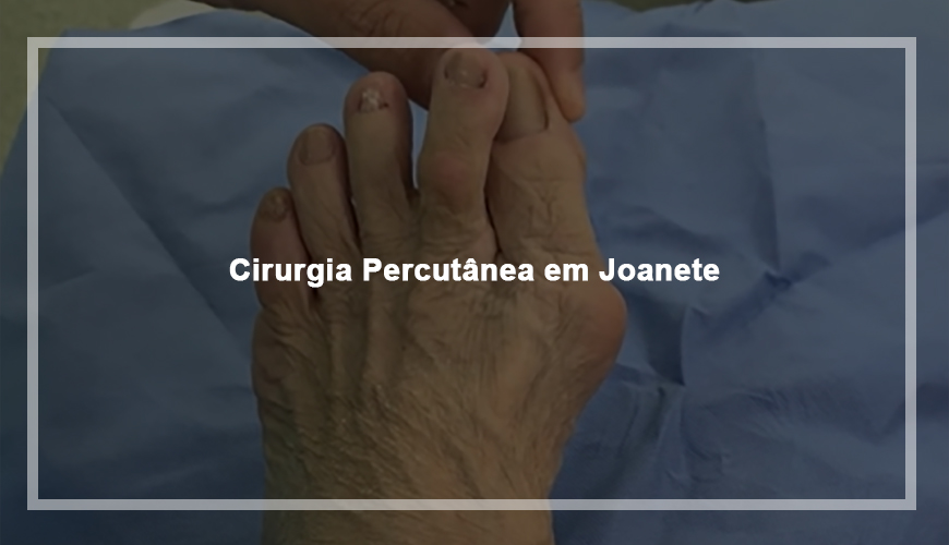 Cirurgia Percutânea em Joanete