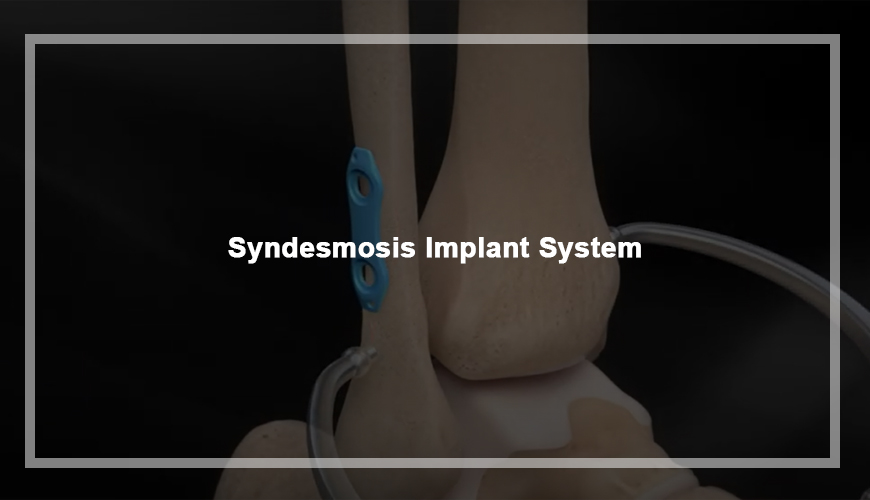 Syndesmosis Implant System