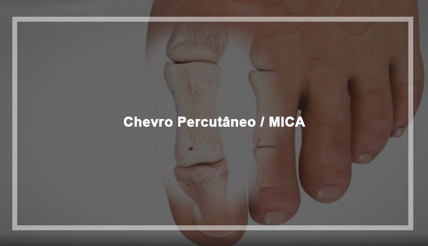Chevro Percutâneo / MICA