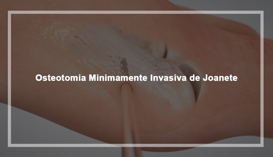 Osteotomia de Joanete Minimamente Invasiva