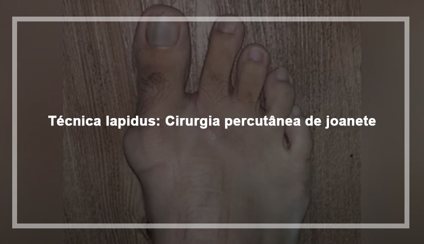 Técnica lapidus: Cirurgia percutânea de joanete